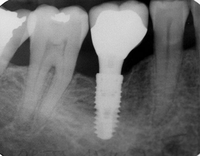 dental implant xray
